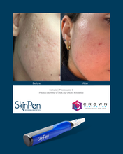 Load image into Gallery viewer, NEW - SkinPen® Precision